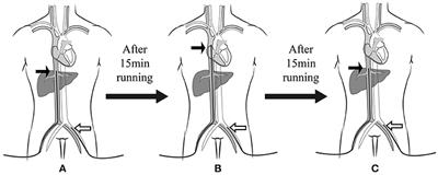 Drainage From Superior Vena Cava Improves Upper Body Oxygenation in Patients on Femoral Veno-Arterial Extracorporeal Membrane Oxygenation